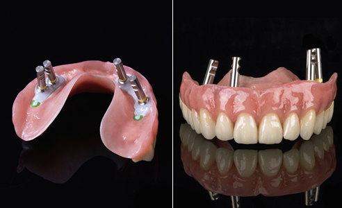 Fig. 12: Primary framework of zirconia with green slide attachment elements and secondary framework of PEEK.
Fig. 13: The highly esthetic final restoration with inserted implant analogs.