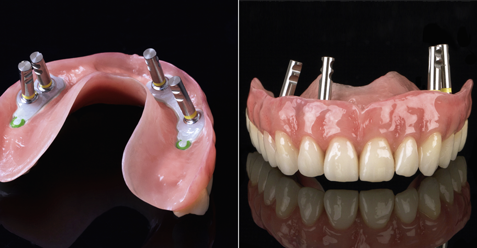 Fig. 12: Primary framework of zirconia with green slide attachment elements and secondary framework of PEEK.
Fig. 13: The highly esthetic final restoration with inserted implant analogs.