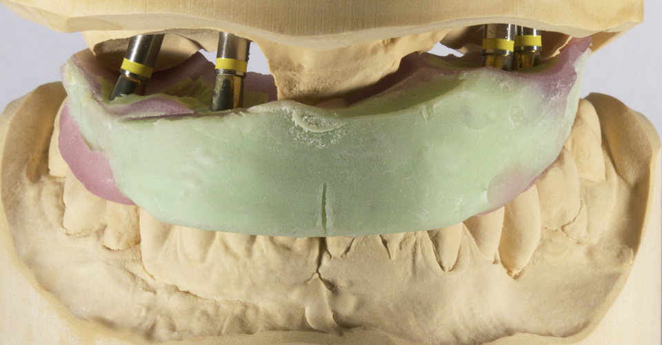 Fig. 2: Un registro de mordida implantatosoportado posibilitó la articulación precisa de ambos modelos maestros.