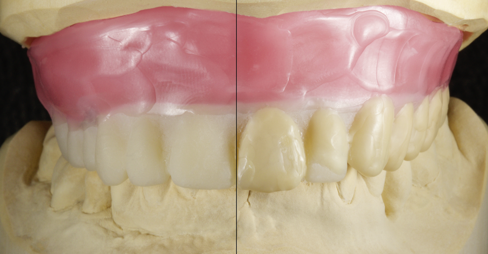 Fig. 3: Su un duplicato in resina della arcata dentaria della vecchia protesi è stato eseguito un wax-up, per definire la situazione auspicata.