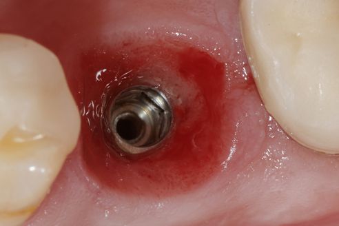Fig. 4 Situation prior to insertion of the abutment crown.